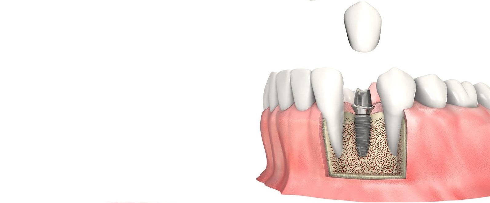 Имплантация зубов под ключ